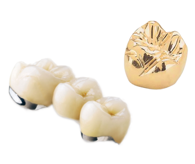 Services.Fixed.MetalBasedRestorations